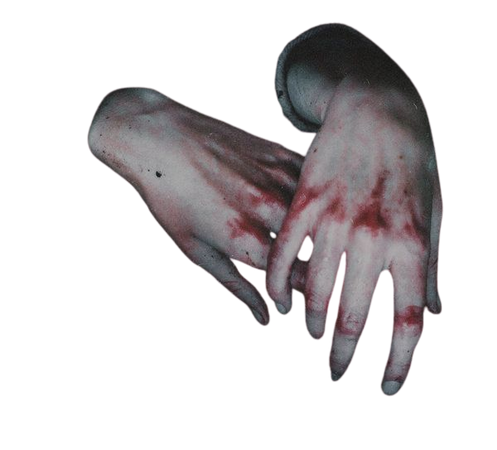 bruised hands