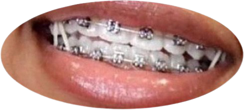 braces 😬