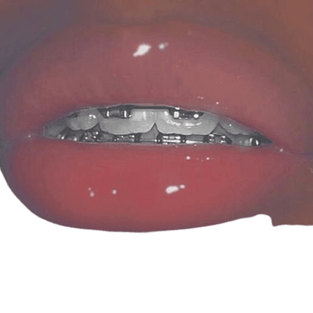braces and lip gloss - Google Search