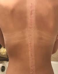 scoliosis scar