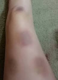 bruise - Google Search