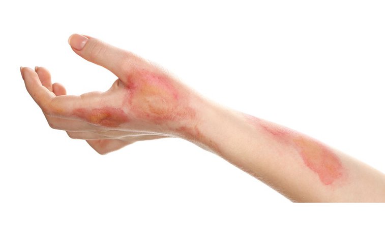 Burned Arm And Hand