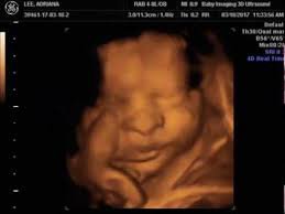 3d 2nd trimester ultrasound photo - Google Search