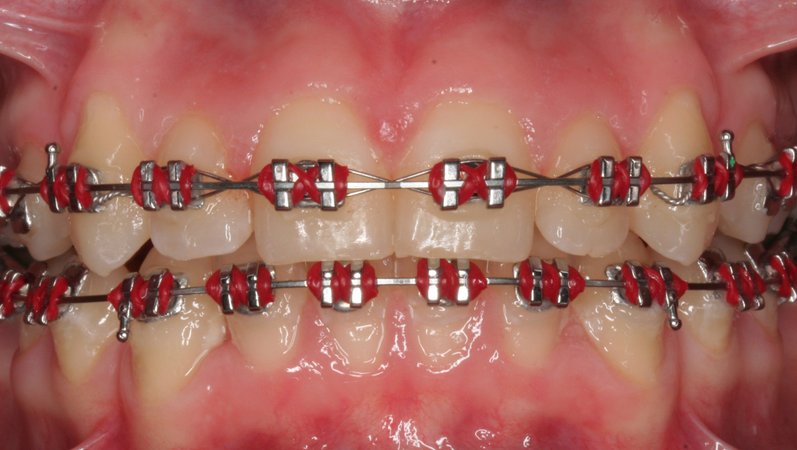 red braces - Google Search