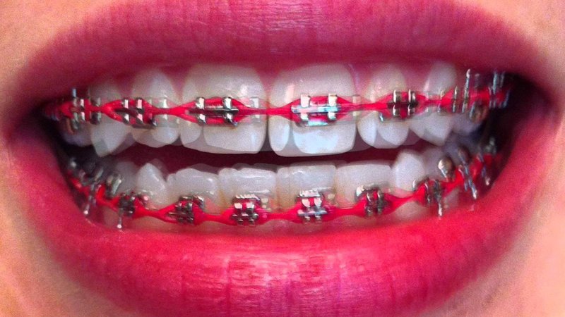 red braces