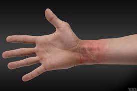 wrist scars from abuse - Google Search