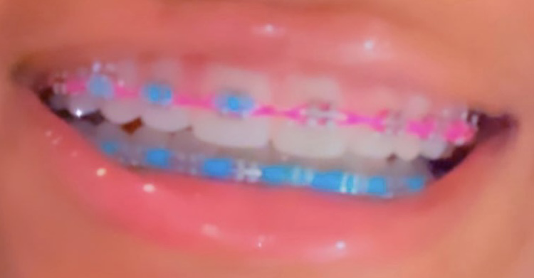 blue and pink braces