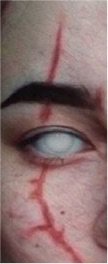 scar over eye