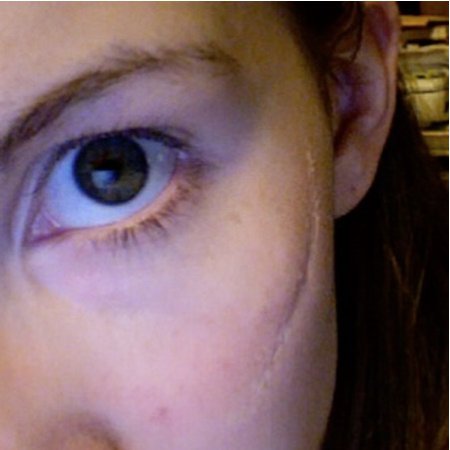 facial scar on cheek