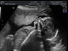 2nd trimester pregnancy ultra sound photos - Google Search
