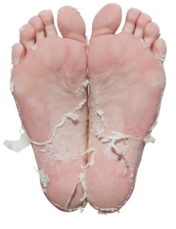 chemical foot peel