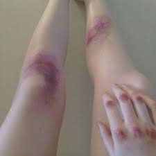 face bruises - Google Search