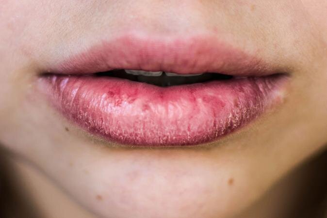dry lips - Google Search