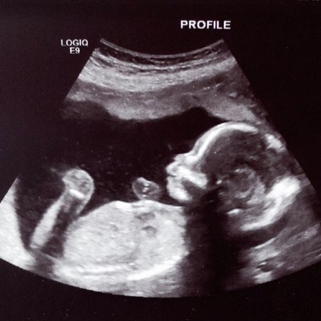 ultrasound 18 weeks pregnant