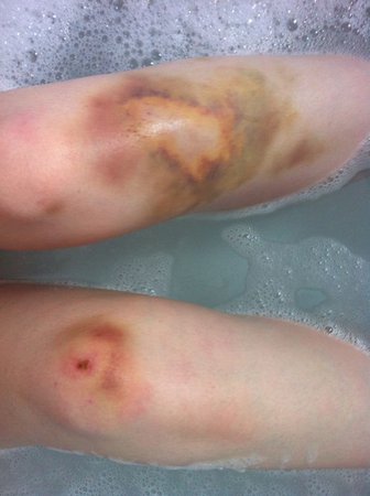 Bruised Bath