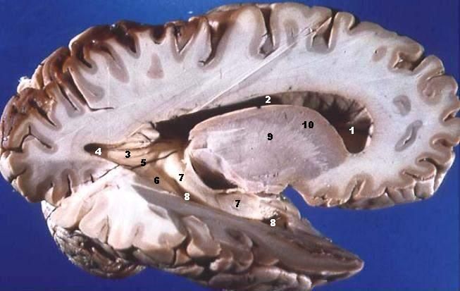 Human brain right dissected lateral view description - White matter - Wikipedia