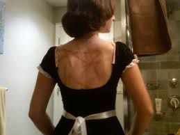back scars