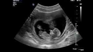 1st trimester ultrasound picture - Google Search