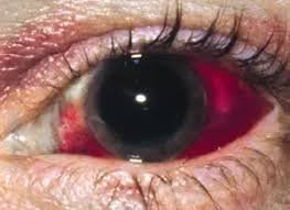 broken blood vessel in eye treatment - Google Search