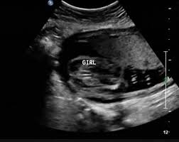 ultrasound pictures - Google Search