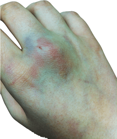 bruises png - Bruise Transparent For Free Download On - Bruise Transparent | #1449102 - Vippng
