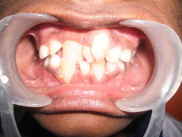 hyperdontia - extra teeth