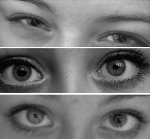 Figure 1 from A 15-year-old girl with variable anisocoria. | Semantic Scholar