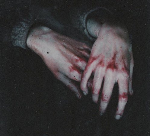 bruised hands