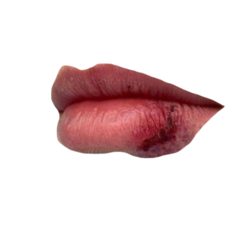 wounded lips