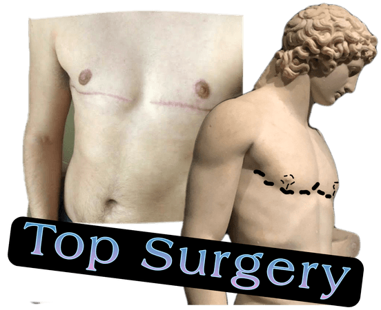 top surgery