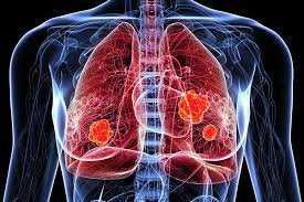 lung cancer - Google Search