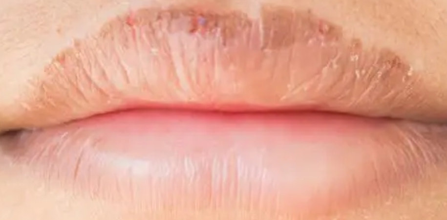 crusty dusty lips
