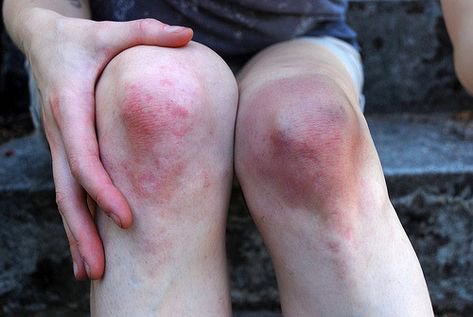 Bruises and Injuries - Knee
