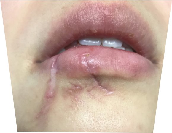 lip scar