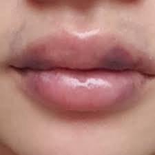 bruised lips - Google Search
