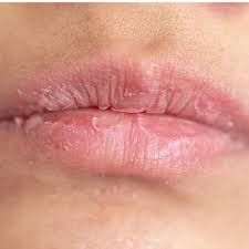 dry lips - Google Search