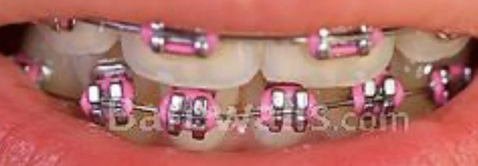 Pink braces