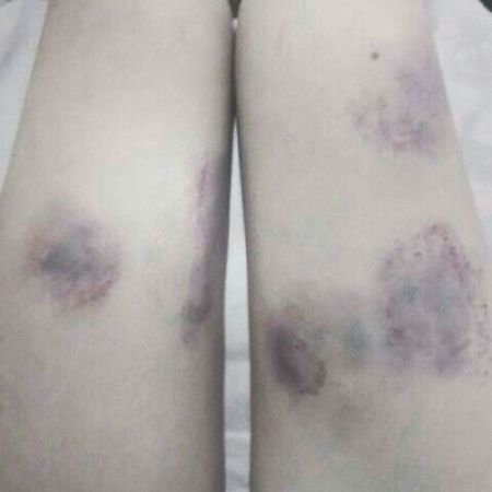 bruises ♡