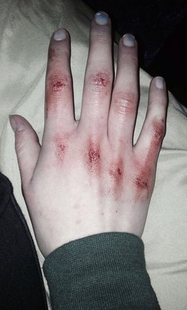 beaten hands