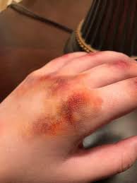 bruised knuckles - Google Search