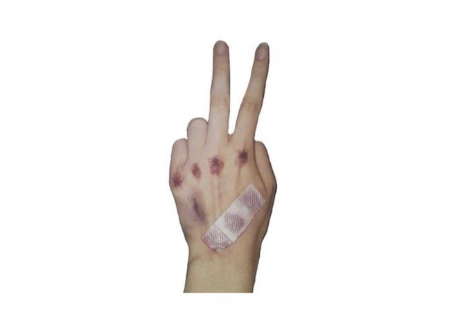 bruised hand
