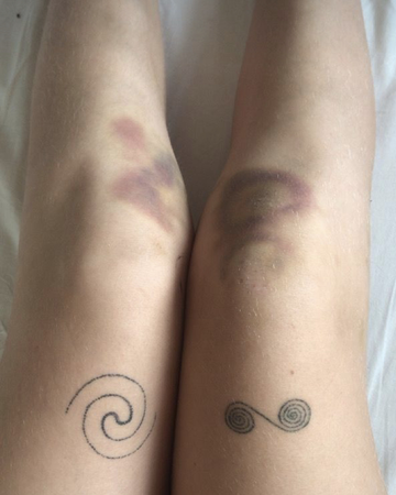 bruised knees