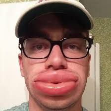 wasp sting on lip - Google Search