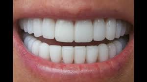 white teeth - Google Search
