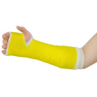 Yellow arm cast