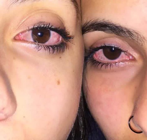 Как выглядят глаза после марихуаны бенинказа купить семена в москве