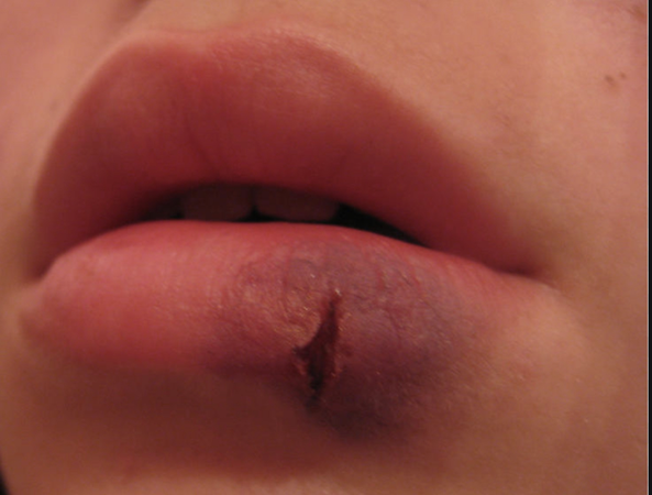 split lip