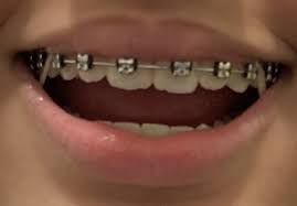 with black braces - Google Search