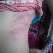 slightly bruised ribs - Google Search