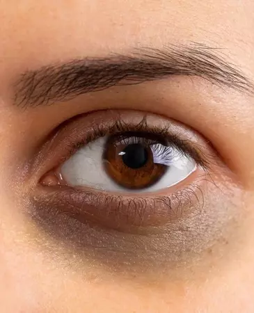 Dark under Eye Circles, Eye Bags and Tear Trough Treatments